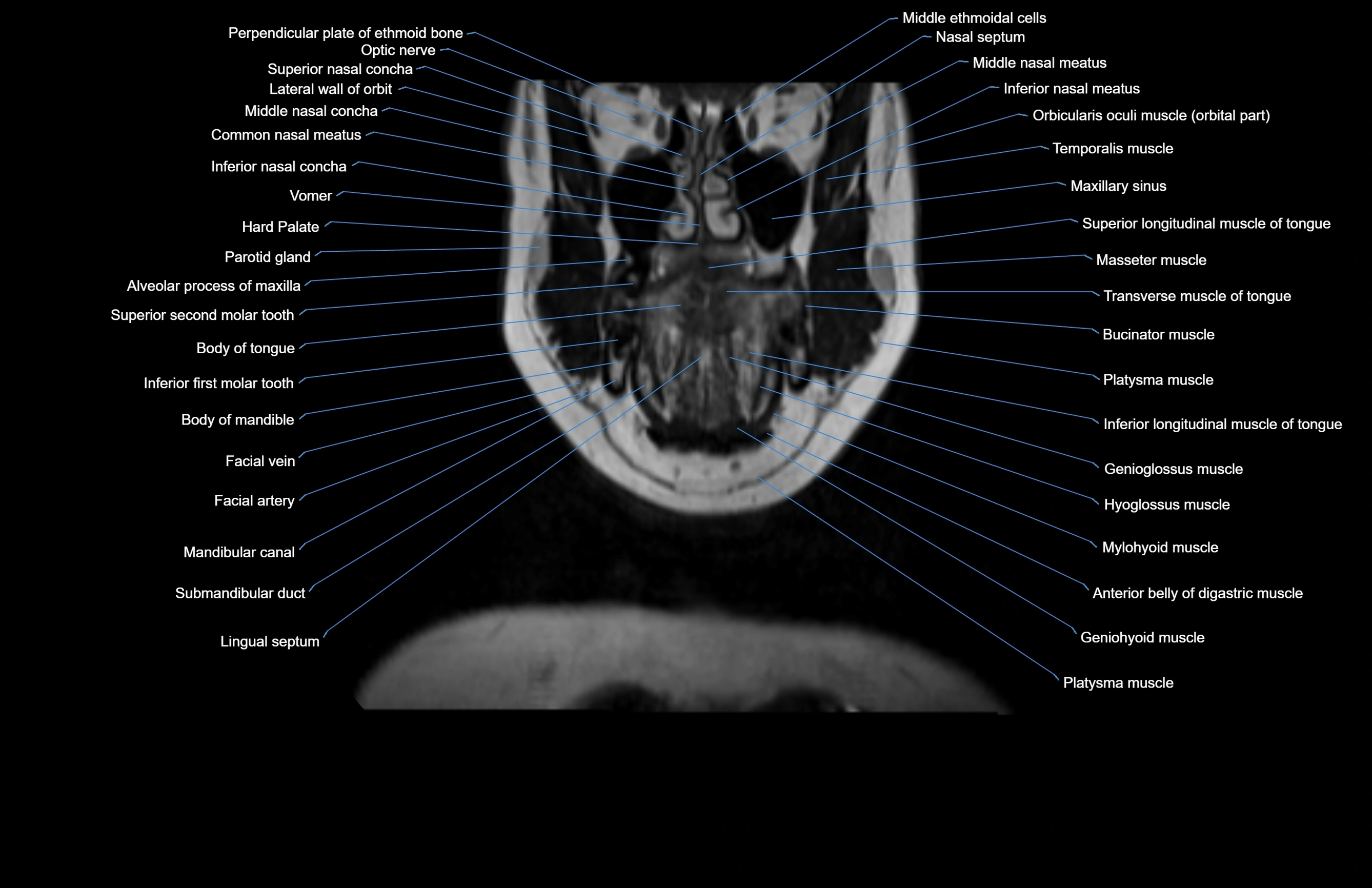 Neck coronal cross sectional MRI anatomy 3T MRI  image-img-00001-00058.webp